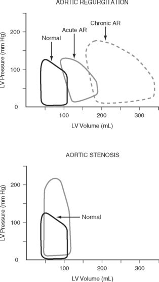 Aortic Stenosis Pressure Volume Loop