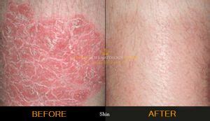 Psoriasis Treatment London Dermatology Clinic