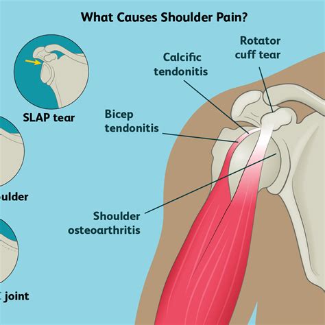 The rotator cuff is a group of muscles and tendons that surround the shoulder joint, keeping the head of your upper arm bone firmly within the shallow socket of the shoulder. Rotator Cuff Shoulder Muscles Diagram - Abbathetwiter