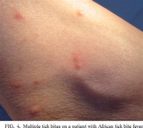 Some of these agents can occur in laboratory rodents. hantavirus: Pictures Of Hantavirus Rash