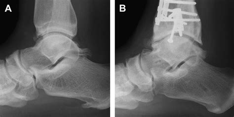 Is There Any Value To Arthroscopic Debridement Of Ankle Osteoarthritis