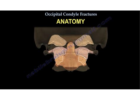 Occipital Condyle Fractures —