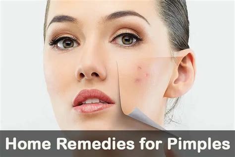 30 Best Natural Ways To Cure Pimples Quickly Wellnessguide