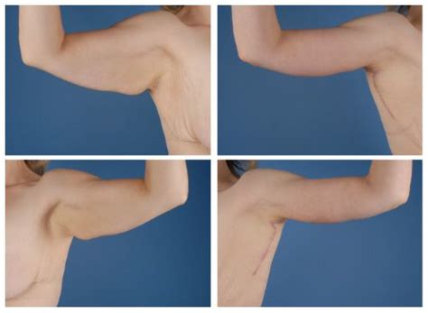 Arm Lift Recovery During Your Recovery From Arm Lift Surgery Dressings