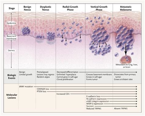 Biologic Events And Molecular Changes In The Progression Of Melanoma