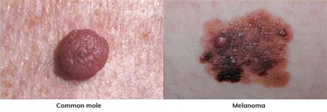 Mole Vs Melanoma Knowing The Difference Could Save Lives