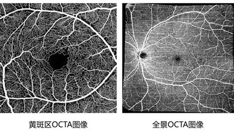 视网膜正常oct图佳能双多模oct影像赏析—正常octandocta图像 Csdn博客