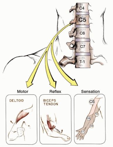 C5 Nerve Root Impingement
