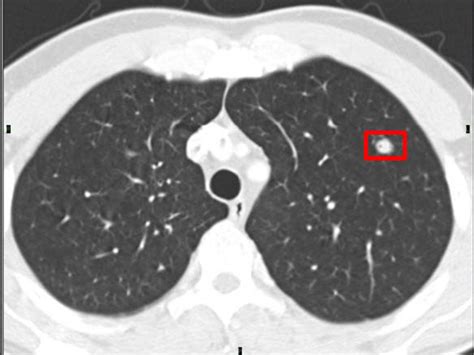 Lung Nodule Malignancy Prediction Based On Sequential Ct