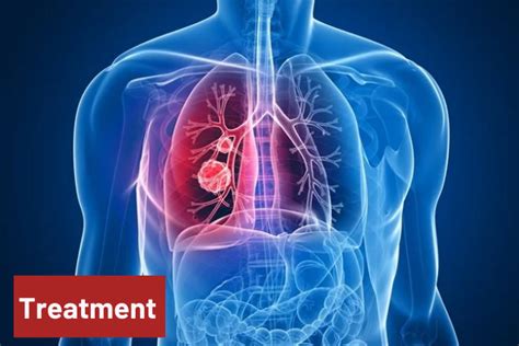 What Is Lung Cancer Symptoms Causes And Treatment