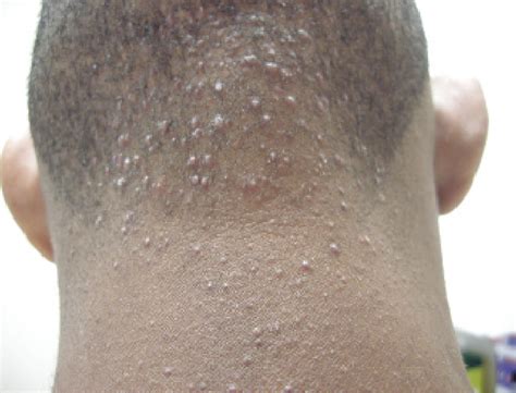 Figure From Acne Keloidalis Nuchae Is Scar And Keloid Formation