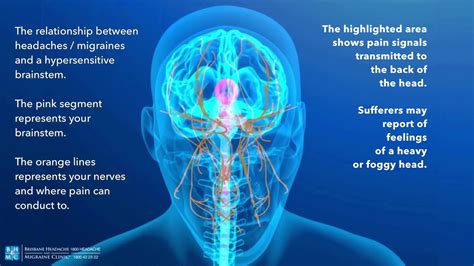 The Brainstem And The Relationship Between Headaches And Migraines