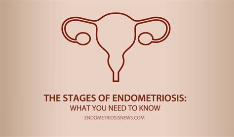 In endometriosis, functioning endometrial tissue is implanted in the pelvis outside the uterine cavity. The Stages of Endometriosis: What You Need to Know
