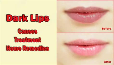 Dark Lips Or Black Lips Causes Treatment And Home Remedies Info