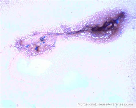 Morgellons Disease Awareness Live Blood Microscopy In A Person