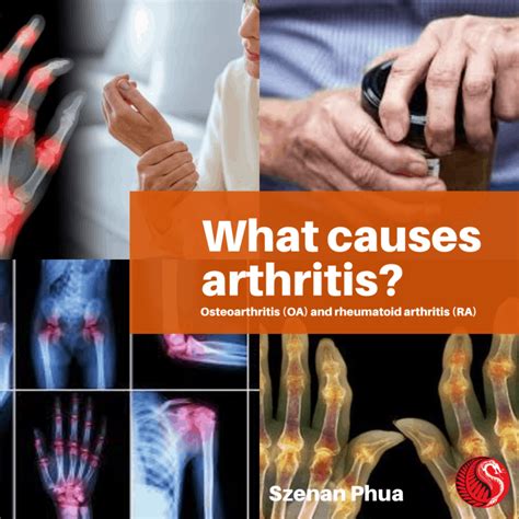 What Causes Arthritis Best Acupuncture Hamilton Nz