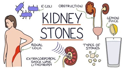 Understanding Kidney Stones Youtube