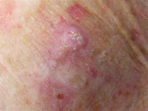 What Is Squamous Cell Carcinoma