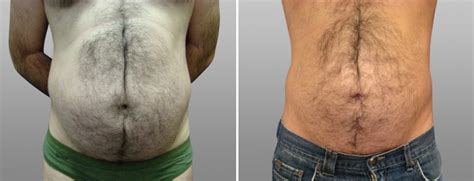 Liposuction Before And After Men