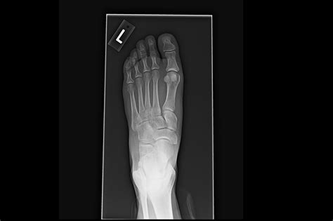 Ortho Dx Foot Pain And Swelling Following Accident Clinical Advisor
