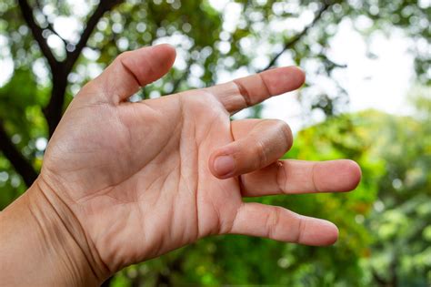 What is the Medical Term for Trigger Finger? | Stenosing Tenosynovitis