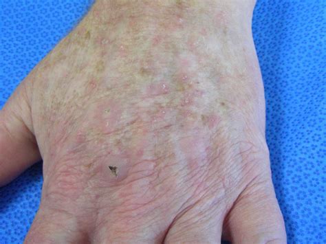 Health From Trusted Sources Actinic Keratoses