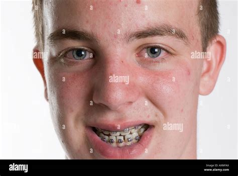 Teenage Boy With Acne And Braces Stock Photo Alamy