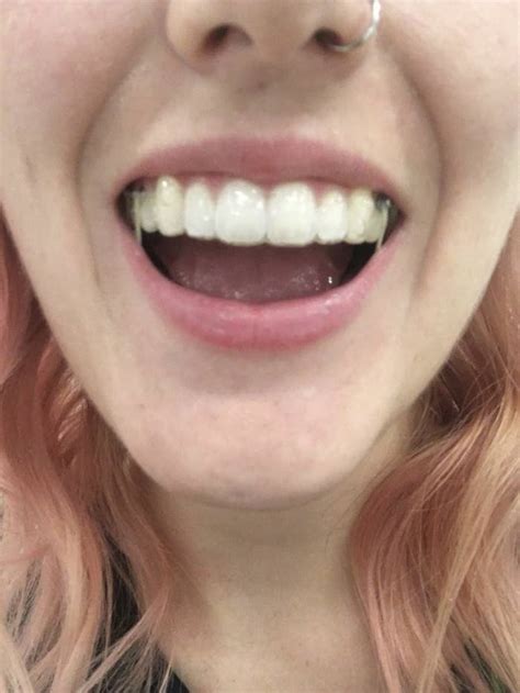 Compare that to traditional braces, which typically take two. Invisalign Review: I've Had It For Two Years And Here's ...