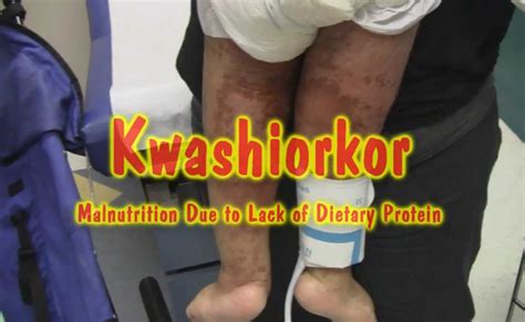 Kwashiorkor Causes Symptoms And Treatment