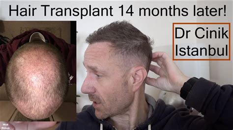 The Hair Transplant Procedure Advanced Clinics Of Oklahoma Ideas