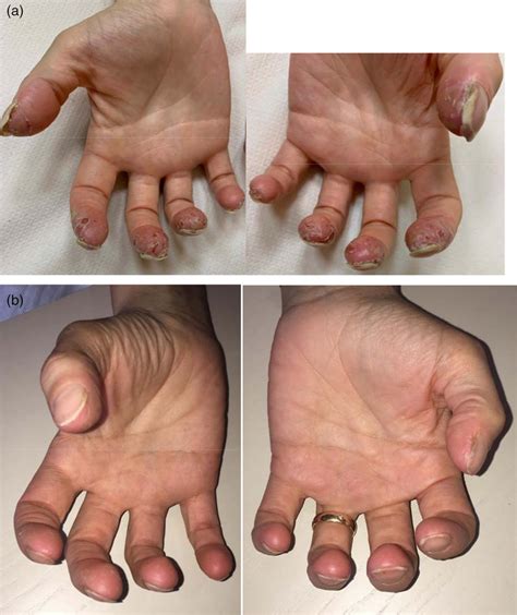 Acrodermatitis Continua Of Hallopeau Before A And After B 2 Weeks