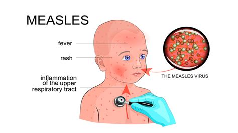 Warning Signs Of Measles That Every Parent Needs To Know Womenworking