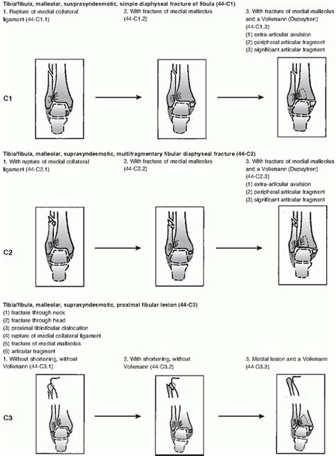 Ankle Fractures Teachme Orthopedics