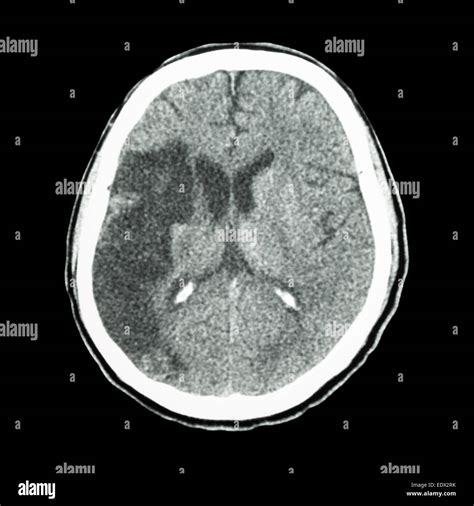Ct Brain Show Ischemic Stroke Hypodensity At Right Stock Photo