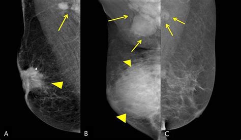 Preoperative Axillary Lymph Node Evaluation In Breast Cancer
