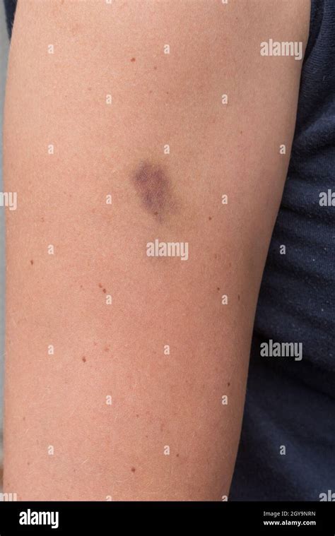 Hematoma Bruise On Woman Arm Pain Concept Closeup Stock Photo Alamy