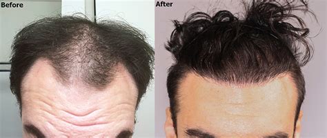 Frontal Hair Restoration With Fue Grafts Alviarmani Hair