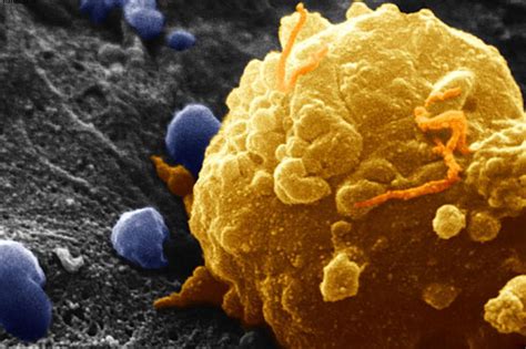 Cytophone detects cancer in earlier stages and prevents fatal disease ...
