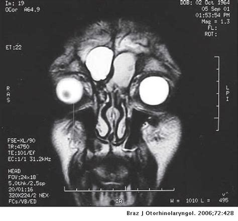 Bilateral Frontal Sinus Mucocele Brazilian Journal Of Otorhinolaryngology