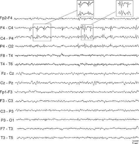 Figure 1 From Seizures And Eeg Pattern In Kabuki Syndrome Semantic