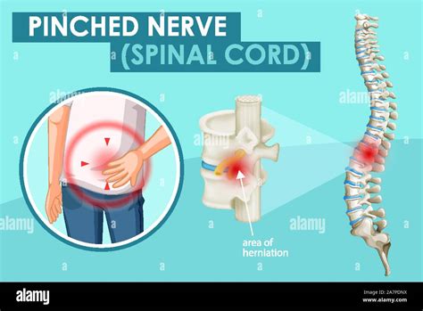Diagram Showing Pinched Nerve In Human Illustration Stock Vector Image And Art Alamy