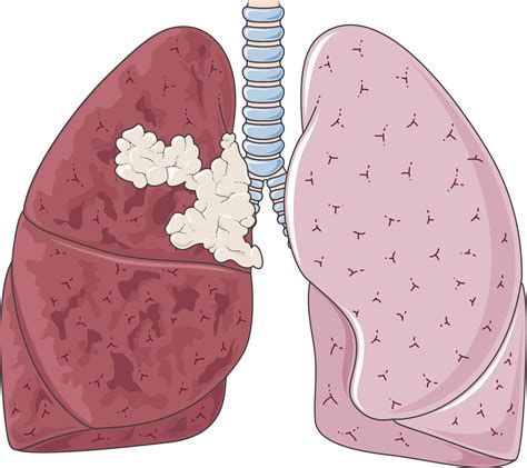 Cancer clipart lung cancer, Cancer lung cancer Transparent FREE for download on WebStockReview 2021