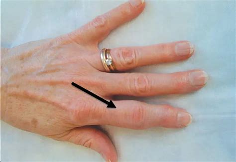 Arthritis In Knuckles Symptoms 5 Warning Signs Body Pain Tips