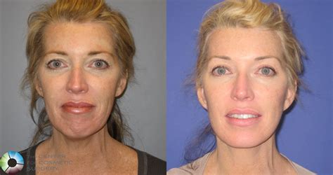 A Facelift Surgery That Makes You Feel Like Yourself Again