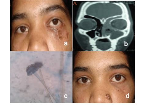 A Photograph Of Patient Showing Facial Cellulitis With Discharging