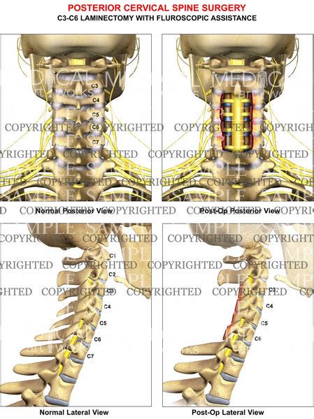3 Level C3 C6 Cervical Spine Posterior Laminectomy — Medical Art Works
