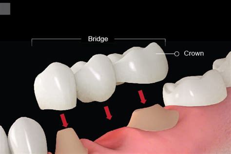 How Can I Get The Best Dental Bridge Procedure Well Being Cares