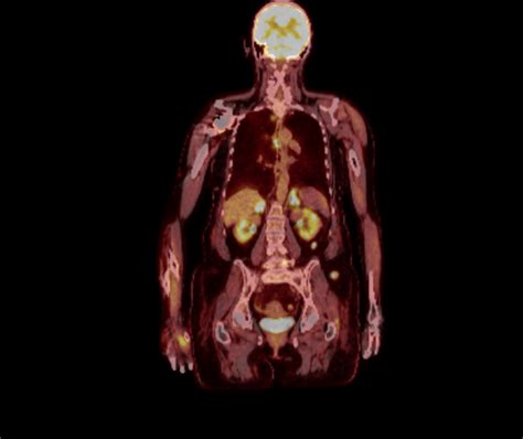 Petct Whole Body Survey Coronal Image Showing Diffuse Metastatic