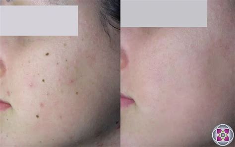 Laser Treatment To Remove Age Spots