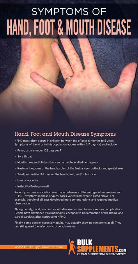Hand Foot Mouth Disease Symptoms Discover 10 Common Hand Foot And